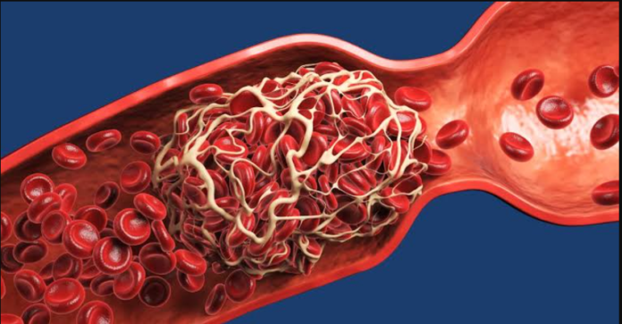 How to Know If You Have a Blood Clot in Your Leg