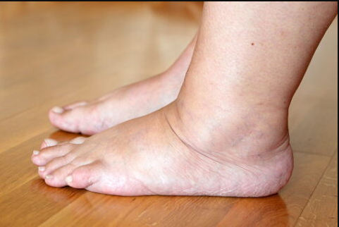 How Do You Know If You Have a Blood Clot in Your Leg?