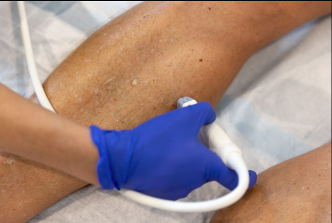 How to Identify a Possible Blood Clot in Your Leg